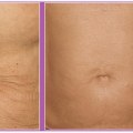Understanding Radiofrequency Skin Tightening