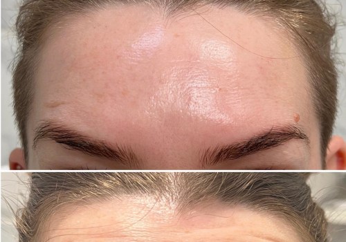 A Comprehensive Look at Botox: Non-Surgical Alternatives for Cosmetic Enhancement